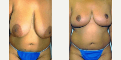 Case 8324 - Woman treated with Breast Lift