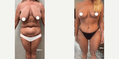 Case 8369 - Woman treated with Breast Lift