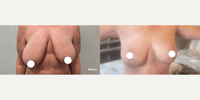 Case 8370 - Woman treated with Breast Lift