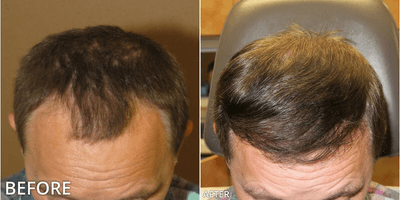 Case 8511 - Man treated with Hair Transplant, ARTAS Robotic Hair Transplant