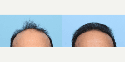 Case 8514 - 45-54 year old man treated with FUE Hair Transplant, Hair Transplant, Hair Loss Treatment, PRP for Hair Loss