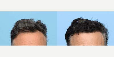 Case 8515 - 55-64 year old man treated with FUE Hair Transplant, Hair Transplant, Hair Loss Treatment, PRP for Hair Loss