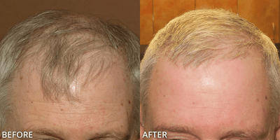 Case 8516 - Man treated with ARTAS Robotic Hair Transplant, Hair Transplant