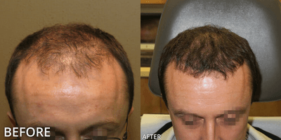 Case 8517 - Man treated with ARTAS Robotic Hair Transplant, Hair Transplant