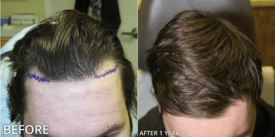 Case 8518 - Man treated with Hair Transplant, ARTAS Robotic Hair Transplant