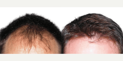 Case 8519 - Man treated with Hair Transplant