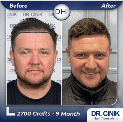 Case 8555 - 35-44 year old man treated with Hair Transplant