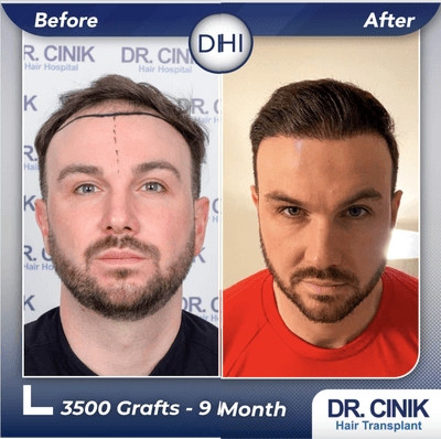 Case 8556 - 35-44 year old man treated with Hair Transplant