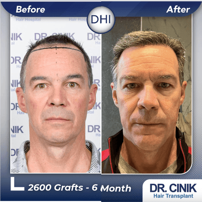 Case 8557 - 45-54 year old man treated with Hair Transplant