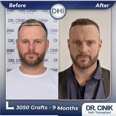 Case 8558 - 35-44 year old man treated with Hair Transplant