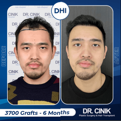 Case 8559 - 25-34 year old man treated with Hair Transplant