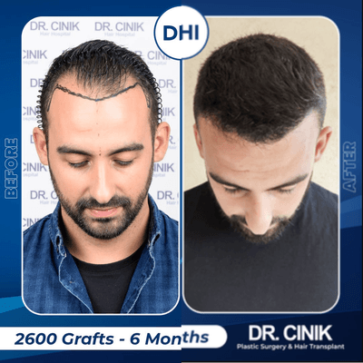 Case 8560 - 25-34 year old man treated with Hair Transplant