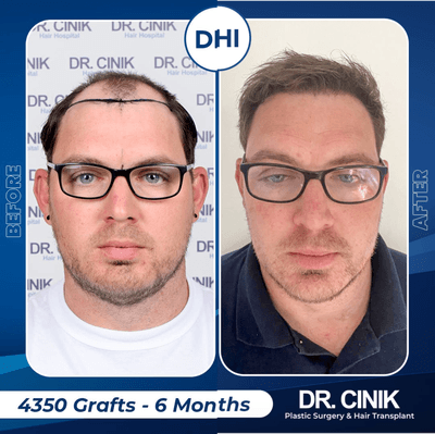 Case 8561 - 35-44 year old man treated with Hair Transplant