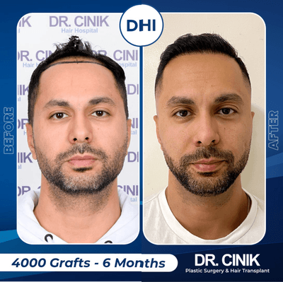 Case 8562 - 35-44 year old man treated with Hair Transplant