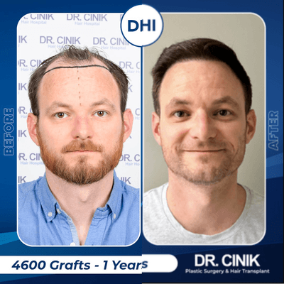 Case 8563 - 35-44 year old man treated with Hair Transplant