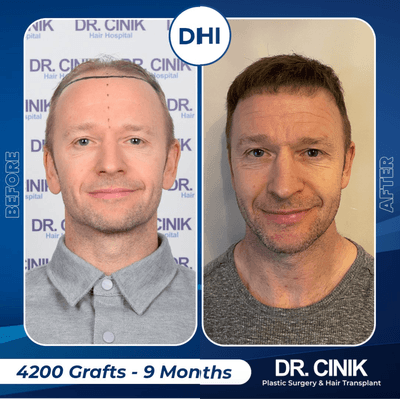 Case 8564 - 35-44 year old man treated with Hair Transplant