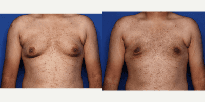 Case 8749 - 18-24 year old man treated with Gynecomastia Surgery