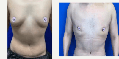Case 8750 - Man treated with Gynecomastia Surgery