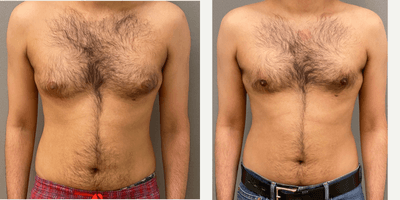 Case 8751 - 25-34 year old man treated with Gynecomastia Surgery