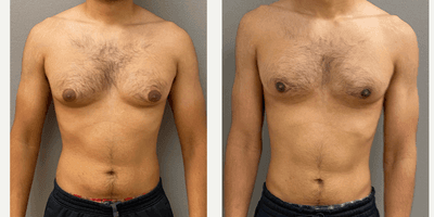 Case 8752 - 18-24 year old man treated with Gynecomastia Surgery