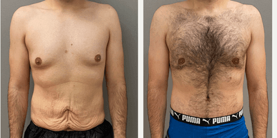 Case 8753 - 25-34 year old man treated with Gynecomastia Surgery, Male Tummy Tuck