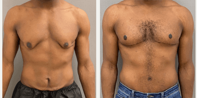 Case 8754 - 25-34 year old man treated with Male Tummy Tuck, Gynecomastia Surgery, Masculinizing Top Surgery