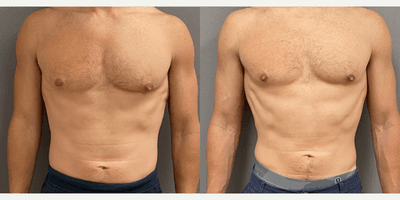 Case 8755 - 35-44 year old man treated with Gynecomastia Surgery