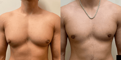 Case 8756 - Man treated with Gynecomastia Surgery