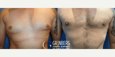 Case 8757 - Woman treated with Gynecomastia Surgery