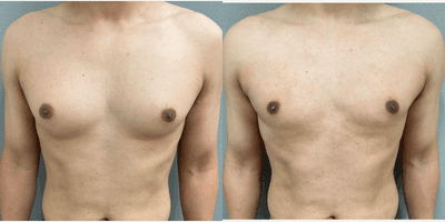 Case 8772 - 35-44 year old man treated with Gynecomastia Surgery