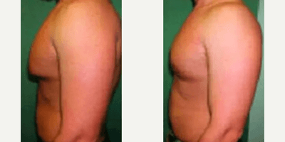 Case 8861 - Man treated with Gynecomastia Surgery