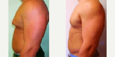 Case 8862 - Man treated with Gynecomastia Surgery