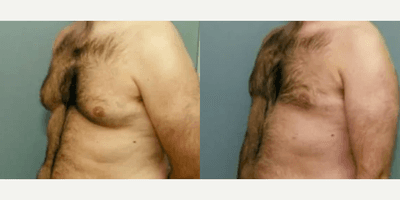 Case 8863 - Man treated with Gynecomastia Surgery