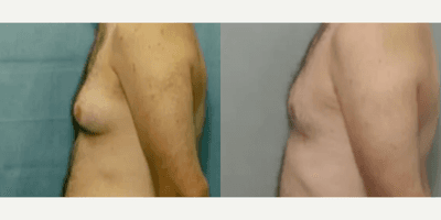 Case 8864 - Man treated with Gynecomastia Surgery