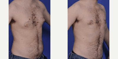 Case 8866 - Man treated with Gynecomastia Surgery