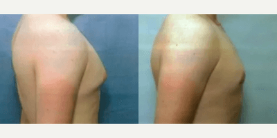 Case 8867 - Man treated with Gynecomastia Surgery