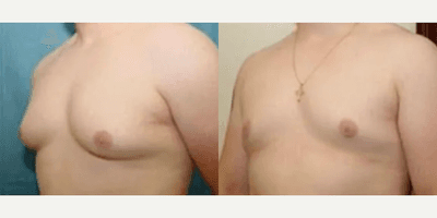 Case 8868 - Man treated with Gynecomastia Surgery