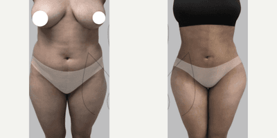 Case 8888 - Woman in her 20s treated with Liposuction