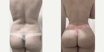 Case 8889 - Woman treated with Liposuction