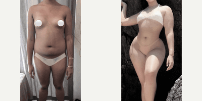 Case 8890 - Woman treated with Liposuction