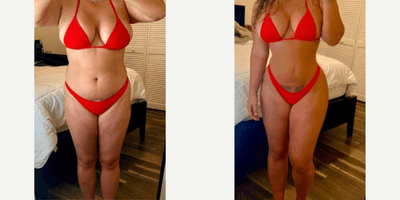 Case 8891 - Woman treated with Liposuction