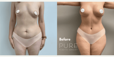 Case 8892 - Woman treated with Liposuction