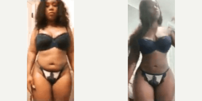 Case 8894 - Woman treated with Liposuction