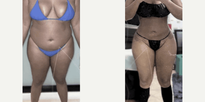 Case 8895 - Woman treated with Liposuction