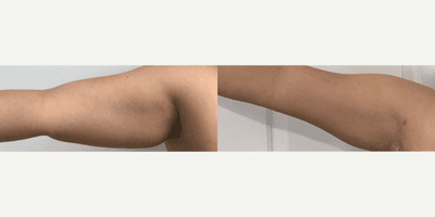 Case 8900 - Woman treated with Liposuction