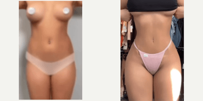 Case 8914 - Woman treated with Liposuction