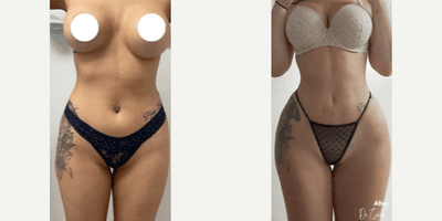 Case 8921 - Woman treated with Liposuction