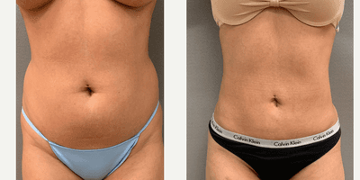 Case 8928 - 25-34 year old woman treated with Liposuction