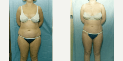 Case 8932 - Woman treated with Liposuction