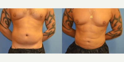 Case 8933 - Man treated with Liposuction